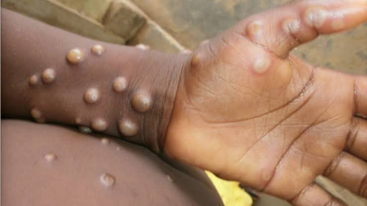 Rubrique Santé : Le Virus Mpox – Comprendre, Prévenir et Traîter… Rubrique Santé : Le Virus Mpox – Comprendre, Prévenir et Traîter…