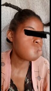 RDC/ MBUJIMAYI :  SOS HUMANITAIRE ,  À 14 ANS, KABEDI MADO A BESOIN D’UNE PRISE EN CHARGE URGENTE