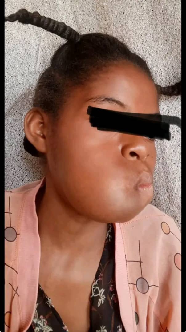 RDC/ MBUJIMAYI : SOS HUMANITAIRE , À 14 ANS, KABEDI MADO A BESOIN D’UNE PRISE EN CHARGE URGENTE RDC/ MBUJIMAYI : SOS HUMANITAIRE , À 14 ANS, KABEDI MADO A BESOIN D’UNE PRISE EN CHARGE URGENTE